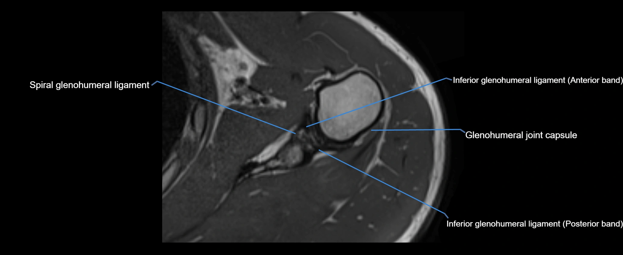 shoulder ligaments axial 3d 3t mri image-img-00005-00084.webp